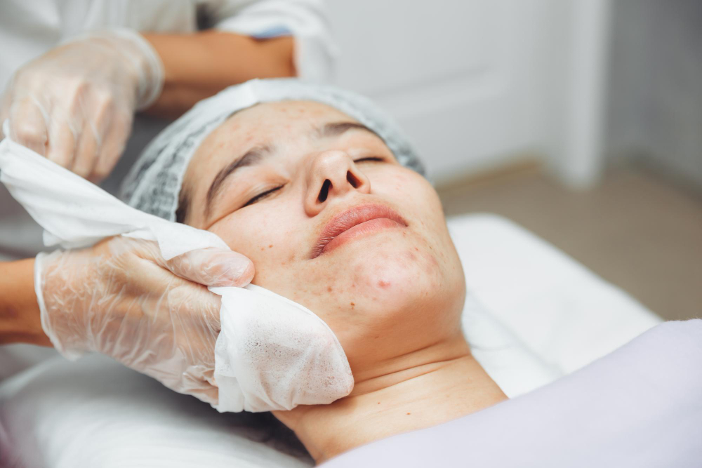 Treating and Preventing Acne Scars: Your Complete Guide