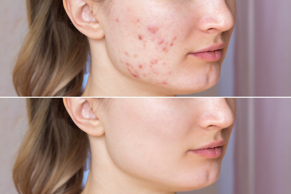 Proven Treatments to Clear Acne for Radiant Skin