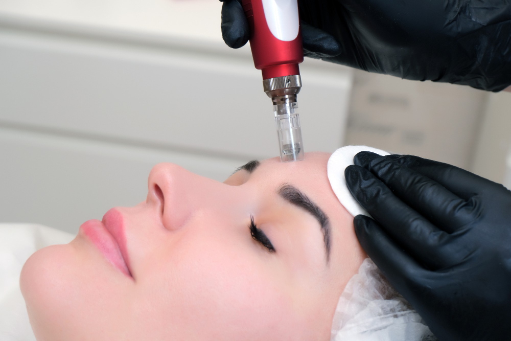 Microneedling: The Science Behind Healthier, Radiant Skin
