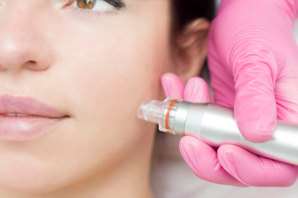 Why You Should Leave Microneedling to the Professionals