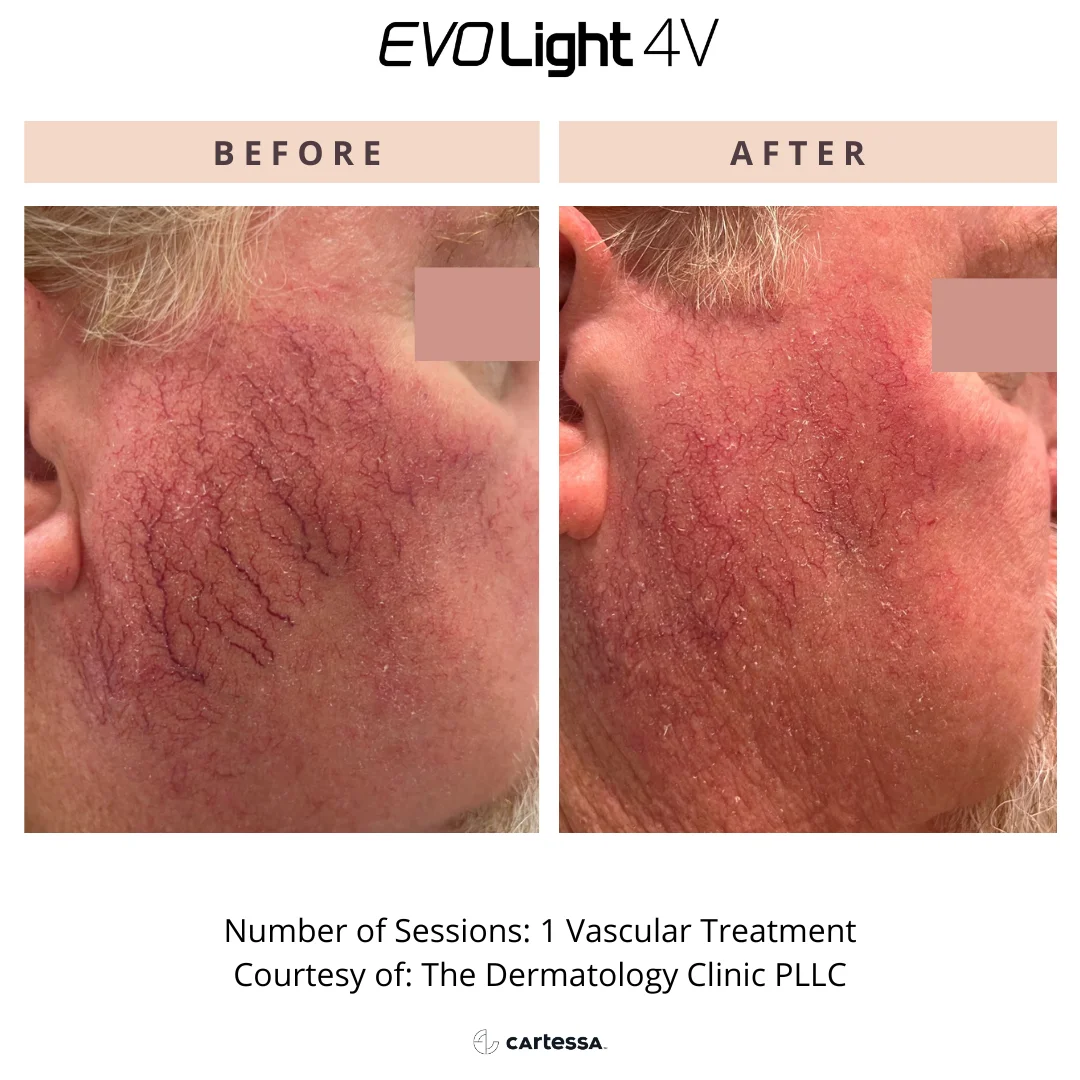 Vein Reduction