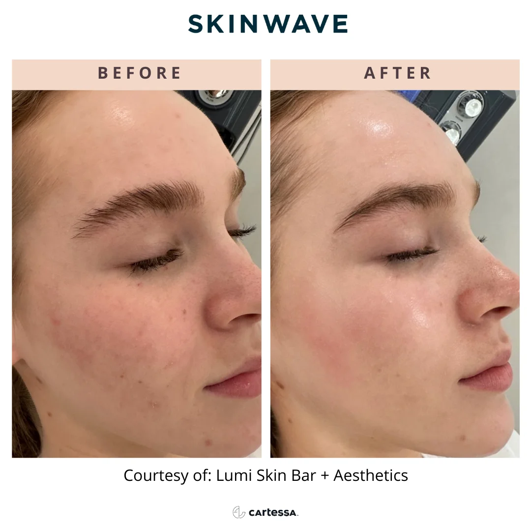 Acne treatment