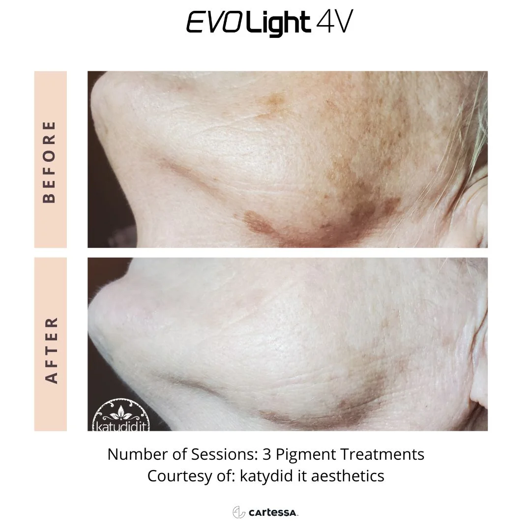 Benign skin removal