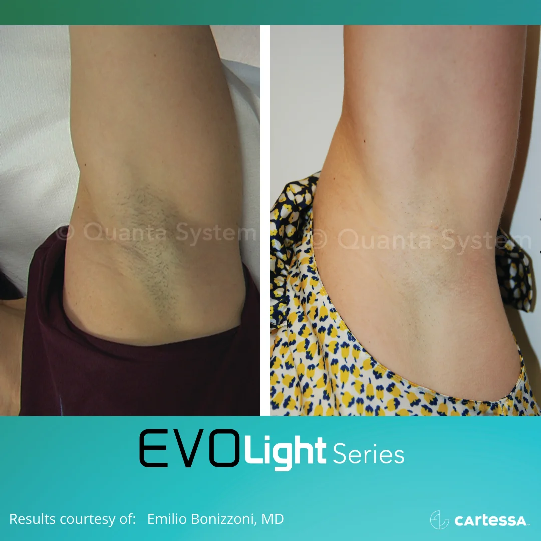 EVO Lighht Series