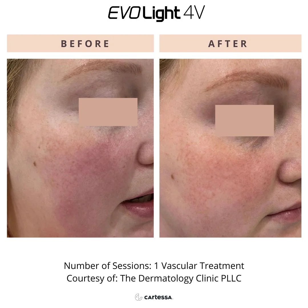IPL Photo Facials