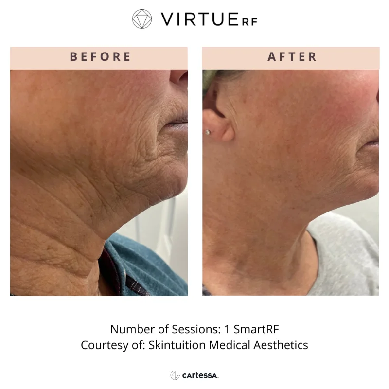 microneedling